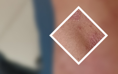 “口碑top前五”广东银屑病研究所新世纪专业-得了牛皮癣吃什么蔬菜可以