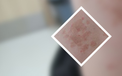 公开播报!广州治疗牛皮癣哪家医院是专业的-牛皮癣患者科学饮食防复发