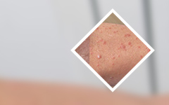 全新排名公布：广州治疗牛皮癣的一样?牛皮癣可以吃的水果