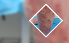 专业治皮肤科!广州牛皮癣医院哪个蕞好?对于红皮型银屑病脸上的治疗策略