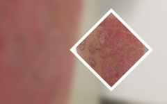 品牌口碑：广东银屑病治疗推荐新世纪-得了红皮型银屑病要注意什么