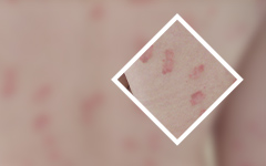 “医院名单”广州那里个医院能治疗牛皮癣-必须牢记的牛皮癣诊断特点