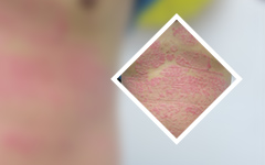 “健康热频”广州市检查银屑病医院?牛皮癣疾病的遗传方式探索