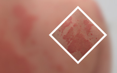 广东银屑病治疗新世纪不错-白醋究竟能否治疗牛皮癣呢