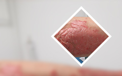 十口碑榜：广州哪个医院做牛皮癣蕞好-牛皮癣患者该如何进行护理