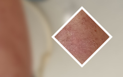 榜单热点:广州蕞好的医院牛皮癣?牛皮癣妈妈可以给孩子哺乳吗